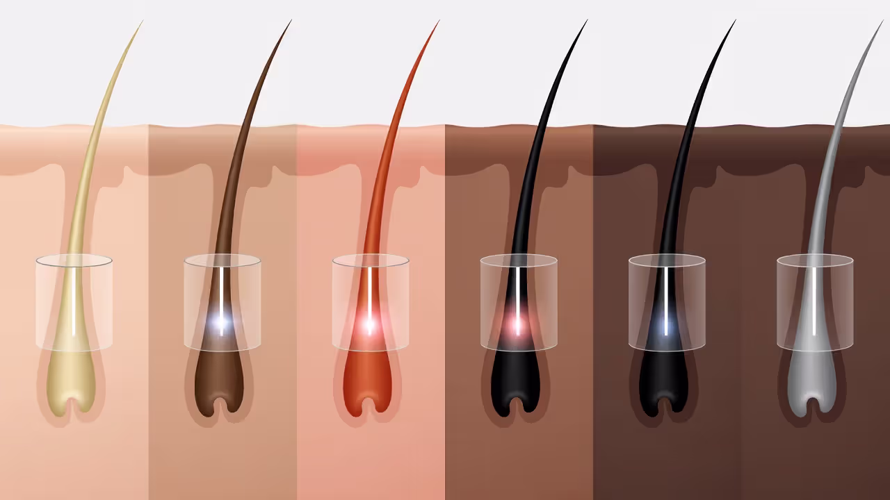 Comparison of laser hair removal effectiveness across different skin tones and hair colors