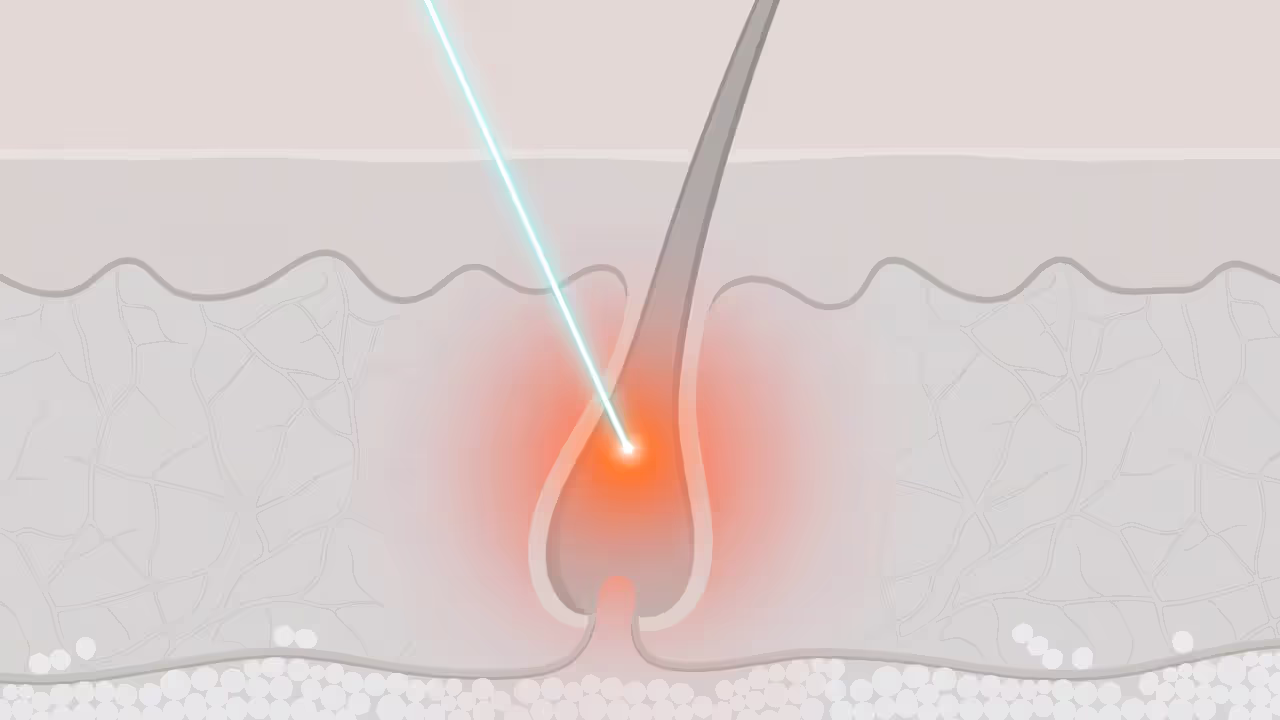 Diagram showing how laser targets the hair follicle during treatment