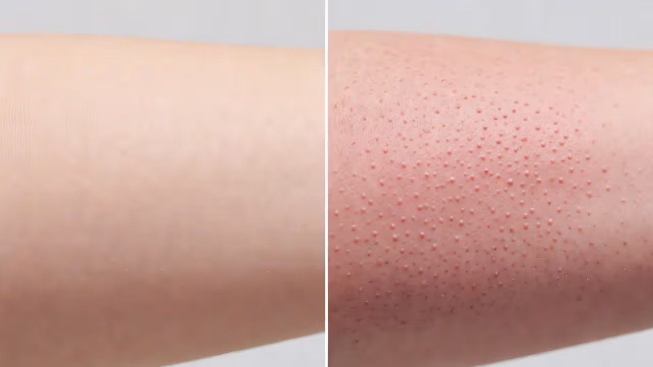 Comparison of skin after laser hair removal versus after shaving