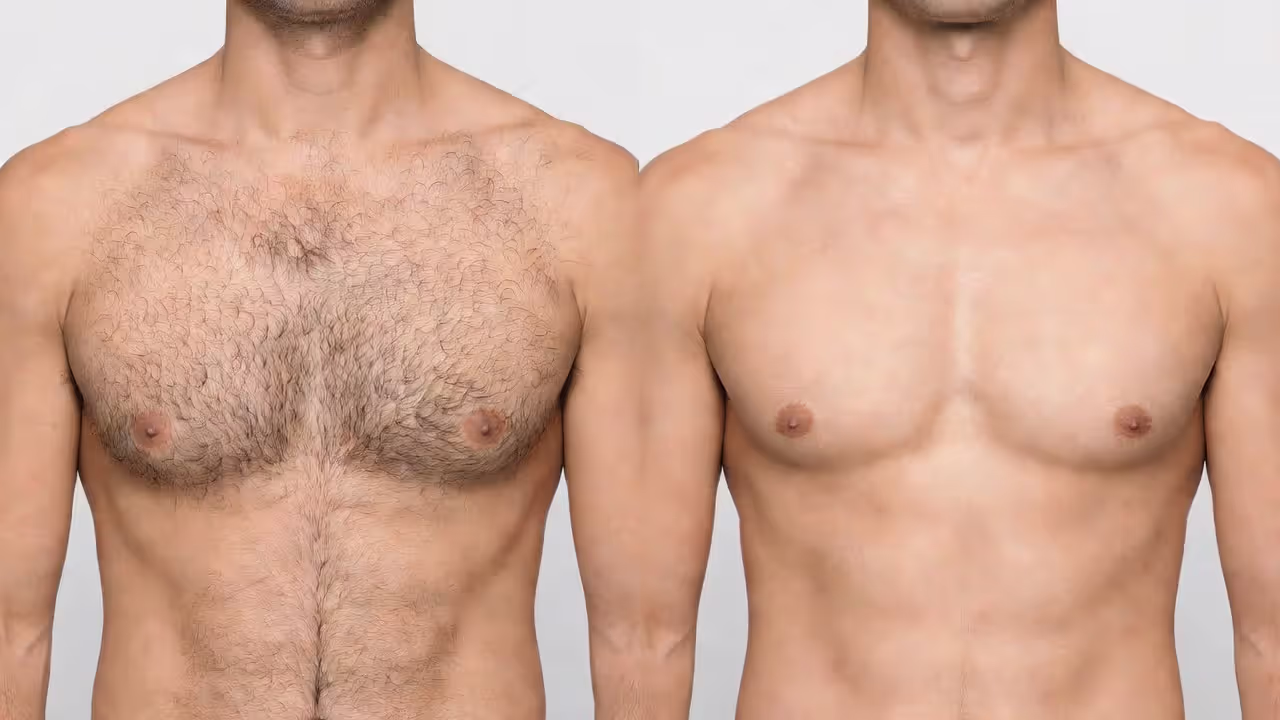 IPL chest hair removal before and after comparison