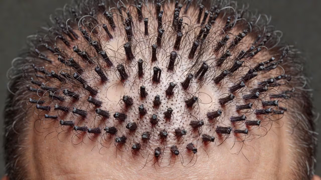 Illustration of hair plug graft pattern showing unnatural doll-hair appearance on scalp