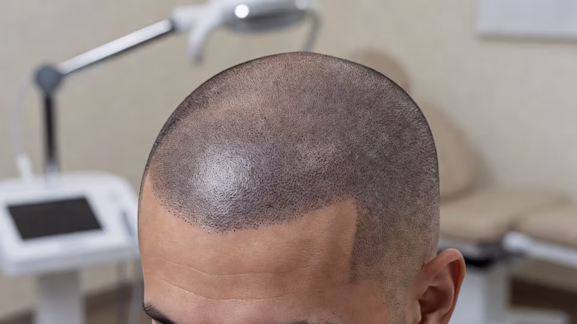 What You Should Know About Scalp Pigmentation Before You Commit