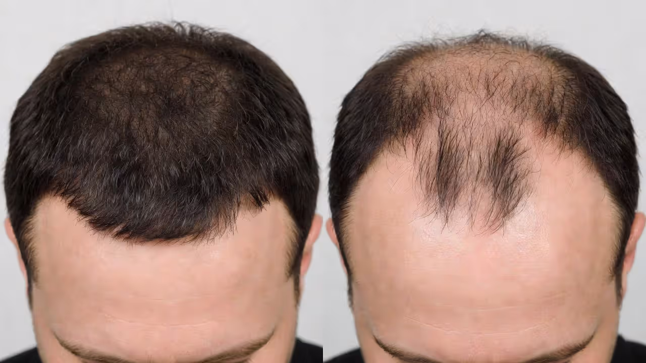Comparison of mature hairline versus receding hairline in adult males