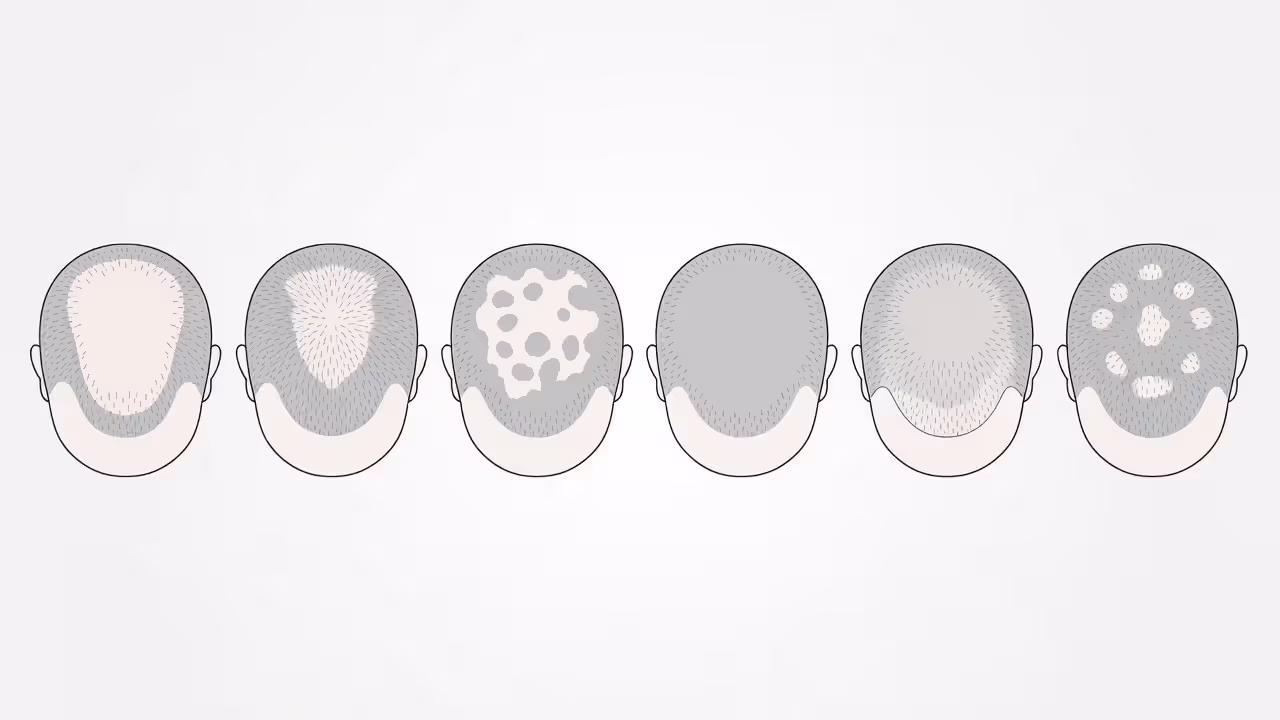 Diagram showing different hair loss patterns for various types of alopecia