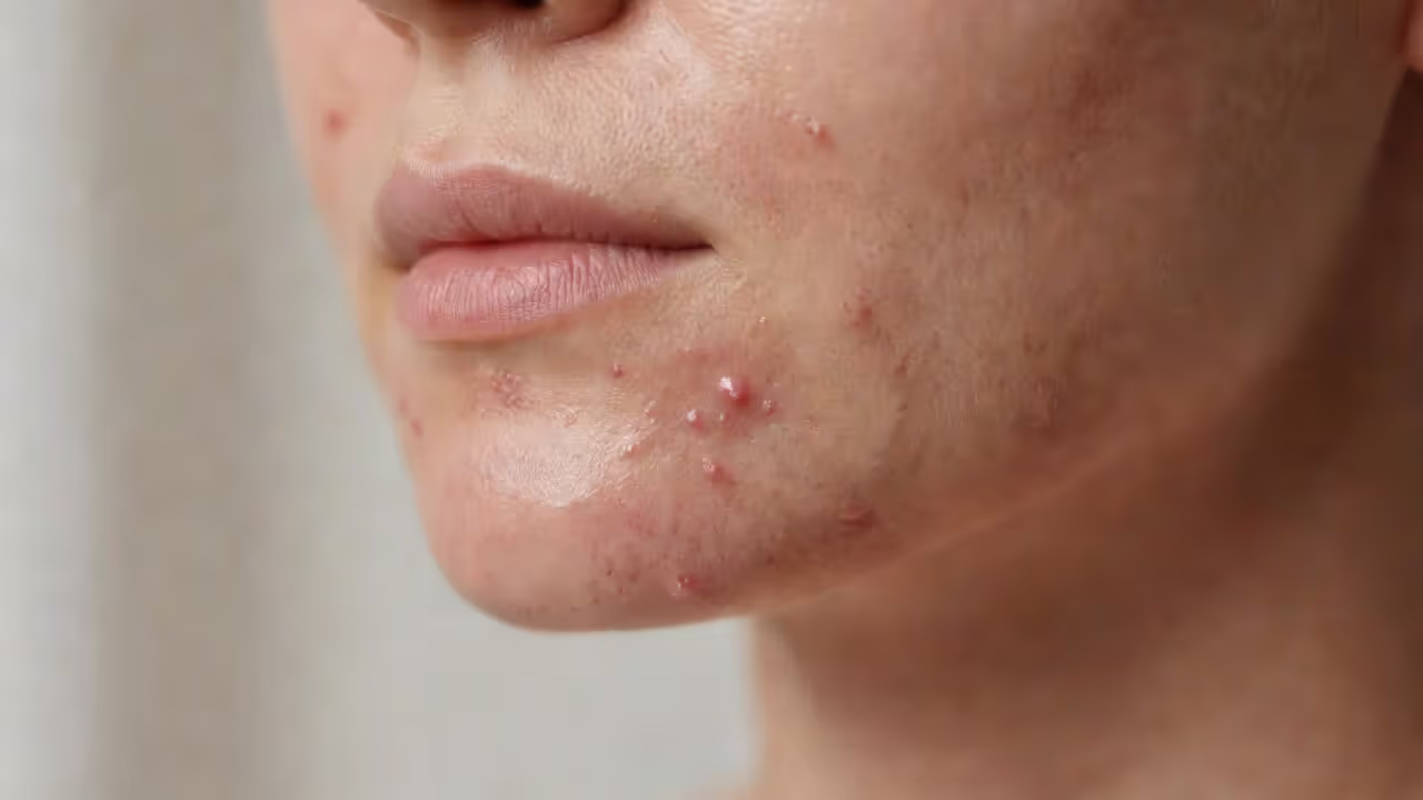 Hormonal acne breakout along the jawline and chin area