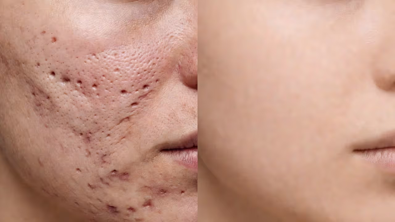 Before and after tretinoin comparison showing pore refinement and acne scar improvement