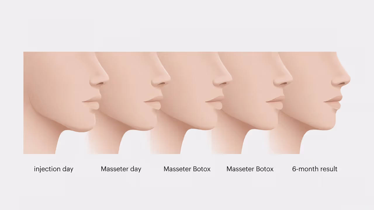 Visual timeline of masseter Botox results from injection to full jaw slimming effect