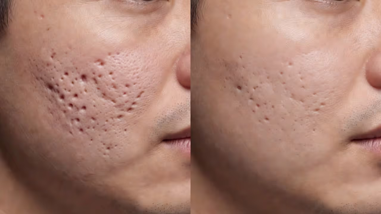 Before and after comparison of male acne scar improvement from microneedling
